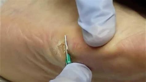 Excision Of Plantar Callus Youtube