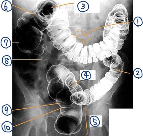 Anatomy X Ray Double Contrast Barium Enema Dcbe Flashcards Quizlet