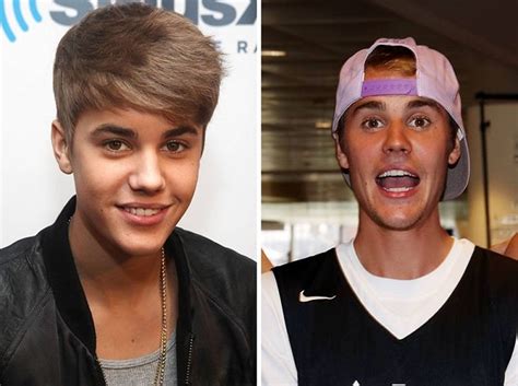 justin bieber before and after plastic surgery
