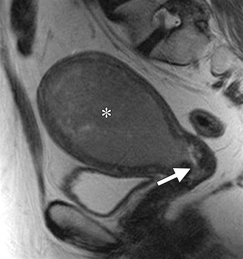 Figo Staging System For Endometrial Cancer Added Benefits Of Mr