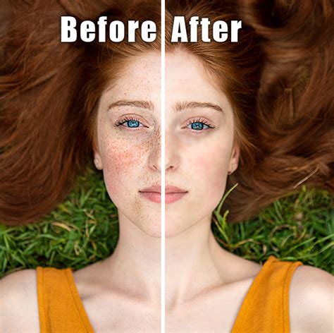 How To Get Rid Of Freckles Health For Best Life