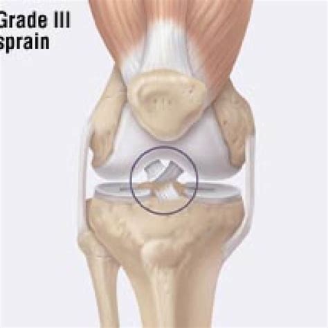 Acl Injury Anterior Cruciate Ligament Sprain What To Do
