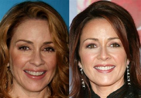Patricia Heaton Looking Great After Plastic Surgery