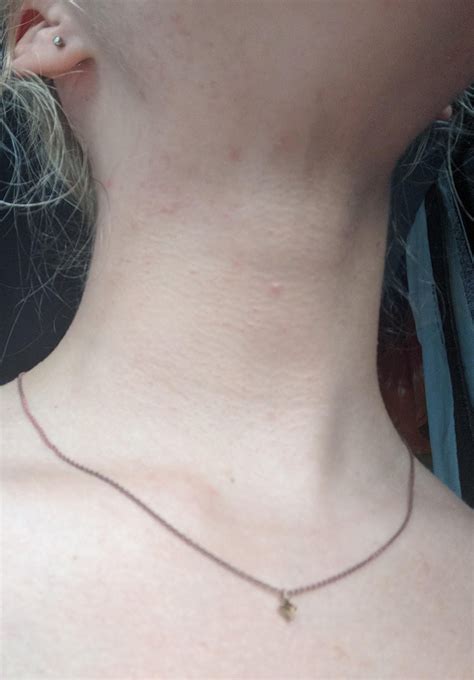 Skin Concerns Ive Been Getting These Bumps On My Neck For The Past