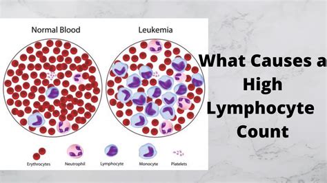 What Causes A High Lymphocyte Count Youtube