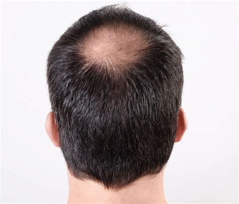 Hair Loss Myth Busted Will You Have A Bald Head Because Your Dad Did