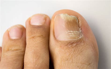Can Discolored Toenails Be A Sign Of Serious Conditions Hyprocure