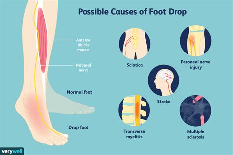 How To Treat Foot Drop With An Elastic Resistance Band