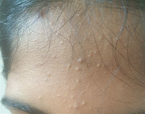 Idk What These Tiny White Bumps Are General Acne Discussion Acne