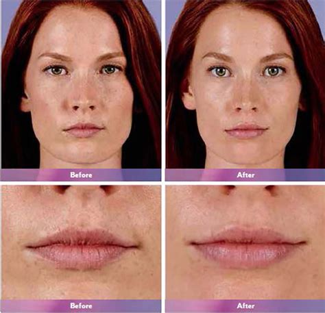 Fillers And Plumpers Premier Aesthetic And Laser Centre Columbus Ohio