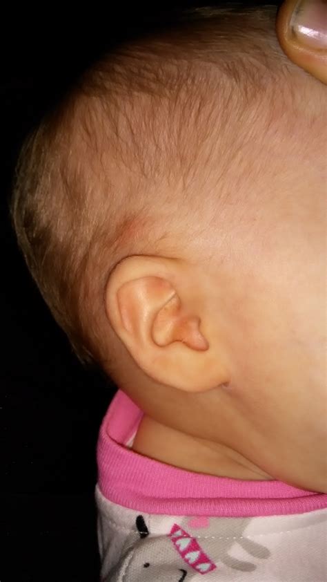 Lump Above Daughters Right Ear October 2015 Babies Forums What