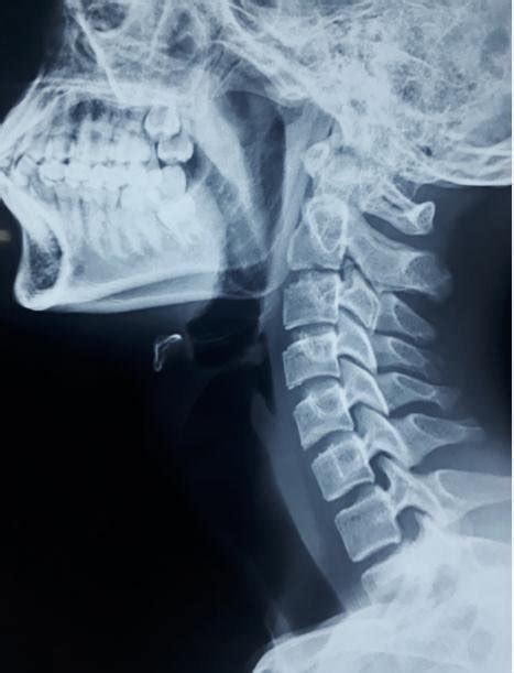 Preoperative X Ray Soft Tissue Neck Lateral View Showing Retroverted