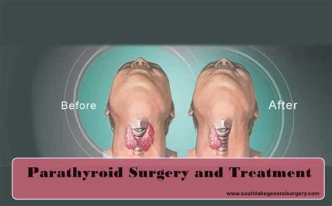 Parathyroid Diseases And Treatments Southlake Southlake General Surgery
