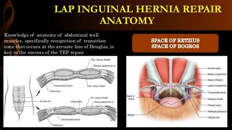 Lap Inguinal Hernia Repair Operative Surgery