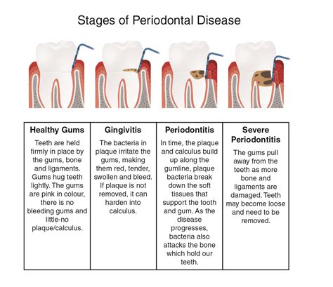 Stages Of Periodontal Disease Chart