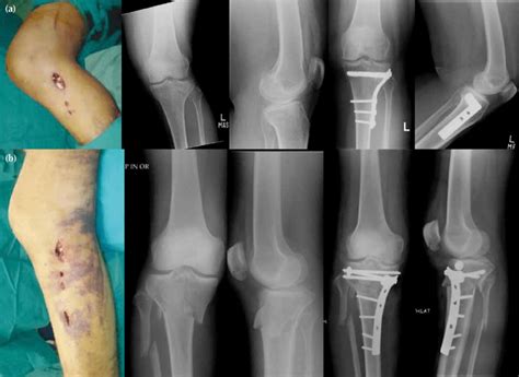 Tibial Plateau Fracture Symptoms Causes Treatment Reh