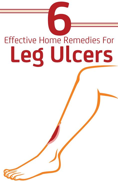 13 Effective Home Remedies To Cure Leg Ulcers Naturally Leg Ulcers