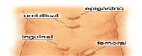 Peninggian tekanan karena kehamilan, obesitas atau asites merupakan factor predisposisi. kumpulan asuhan keperawatan: Askep Hernia Umbilikus