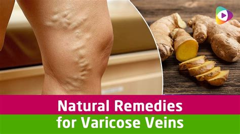Natural Remedies For Varicose Veins Vein Treatment Youtube