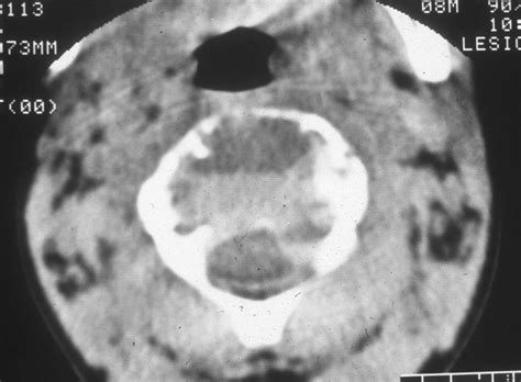 Tumor Library Case Detail Aneurysmal Bone Cyst Cervical Spine