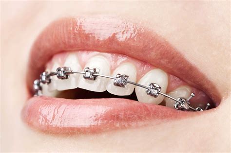 Orthodontic Treatment My Smile