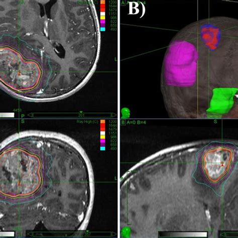 Gadolinium Enhanced T1 Weighted Magnetic Resonance In Sagittal Axial