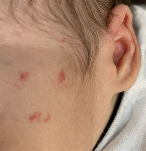 What Are These Smooth Red Marks On Babys Face I Searched For All
