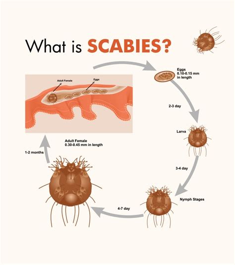 Scabies In Kids Causes Symptoms Diagnosis And Treatment