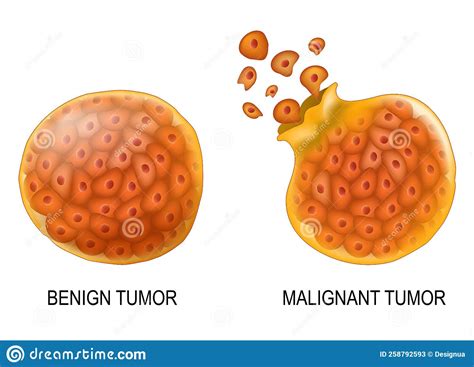 Cancer Cells In Benign Neoplasm And Malignant Tumors Stock Vector