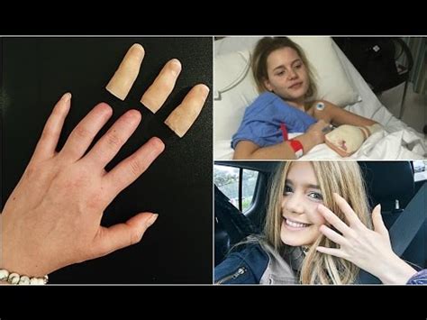 My Amputated Fingers Prosthetics WARNING GRAPHIC YouTube