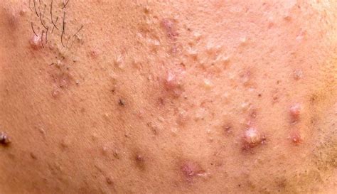 Acne Papules Vs Pustules And Symptoms Causes And Treatment 2023