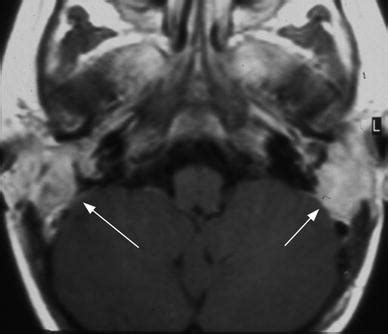 Of The Jugular Foramen Radiology Key