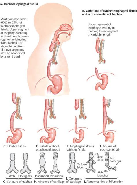 Tracheoesophageal Atresia Nursing Care Management Study Guide Nurseslabs