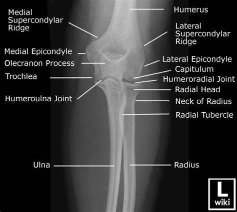 Elbow Injuries Emcage