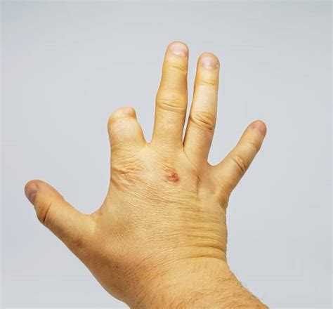 Best Amputated Finger Stock Photos Pictures And Royalty Free Images Istock