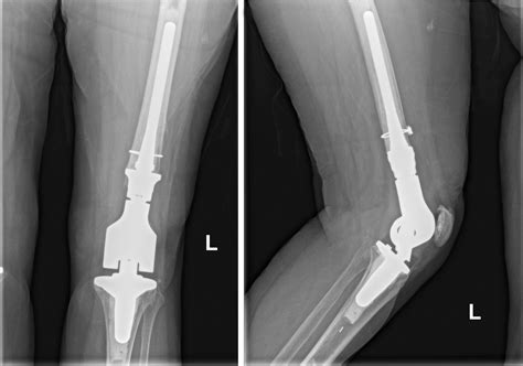 Single Stage Bilateral Distal Femur Replacement For Traumatic Distal