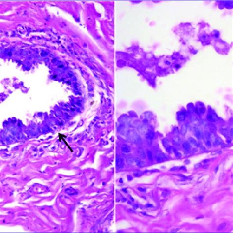 A 1b And 2a 2b Two Cases Of Invasive Duct Carcinoma Showing