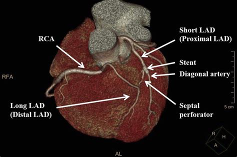 Dual Supply Of Left Anterior Descending Coronary Artery On Coronary