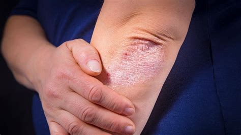 Psoriasis Vs Eczema Images And Key Differences Goodrx