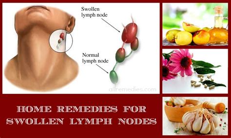 30 Home Remedies For Swollen Lymph Nodes In Neck And Throat