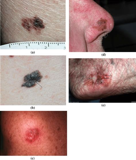 Clinical Images Of Types Of Melanoma A Superficial Spreading Melanoma
