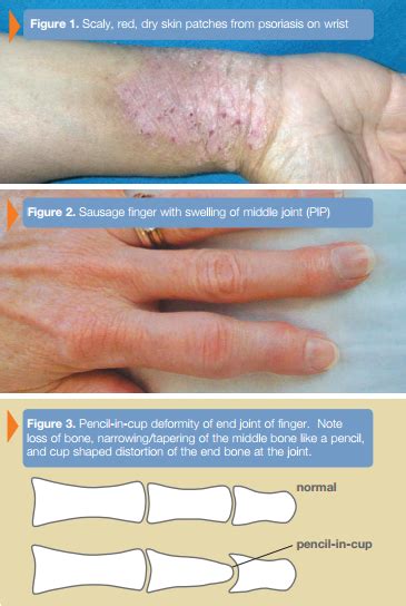 Psoriatic Arthritis Macomb St Clair Shores Mi Arora Hand Surgery