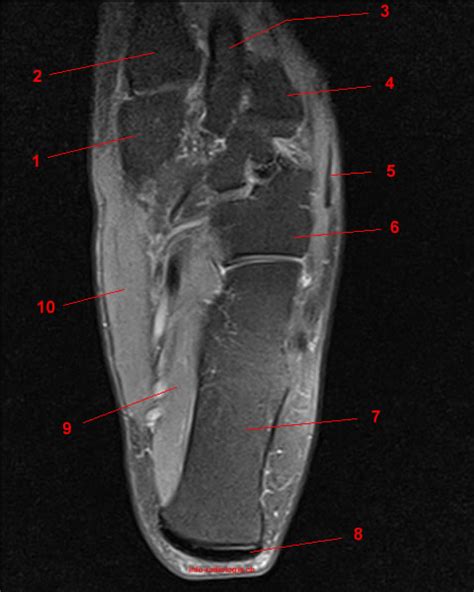 Magnetic resonance imaging (mri) is the modality of choice in diagnosing accessory muscles, delineating their relationship to adjacent structures, and differentiating them from soft tissue tumors. Anatomie IRM de la cheville