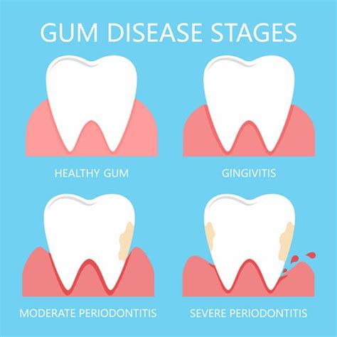 What Is Gum Disease Oral Care
