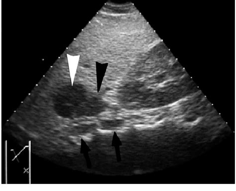 A Case Of Diffuse Enlargement Of The Right Adrenal Gland Due To