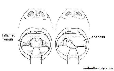 Chronic Pharyngitis Pptx عبدالله Muhadharaty