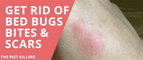 How To Get Rid Of Bed Bug Scars And Bites Thepestkillers