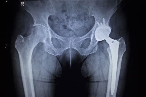 Texas Stryker Hip Replacement Class Action Lawyer Tx Lawsuit