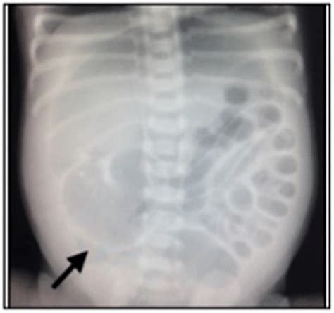 X Ray Abdomen Ap Supine View Showing Dilated Loops And A Download