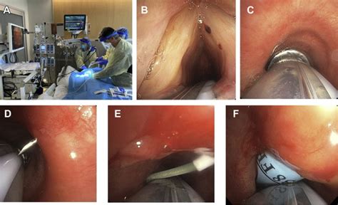 Novel Percutaneous Tracheostomy For Critically Ill Patients With Covid